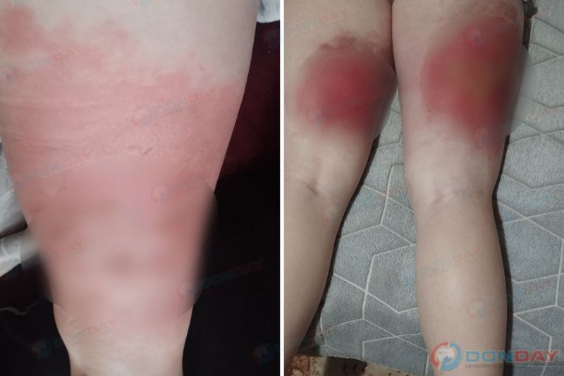В Ростовской области молодая мама получила ожоги второй степени из-за лопнувшего смесителя